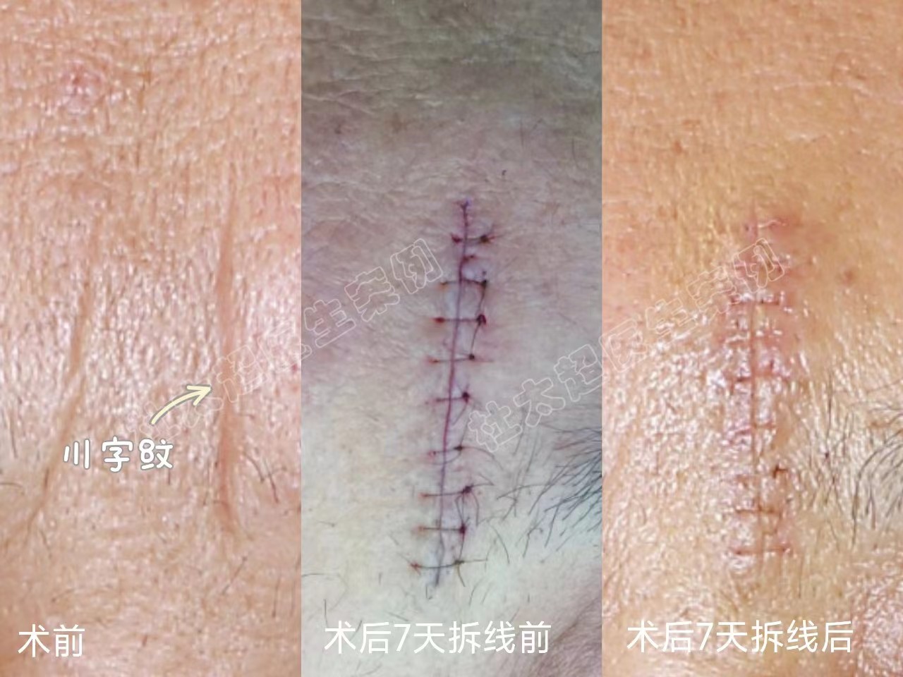 川字纹去除多少钱？不同案例分享效果