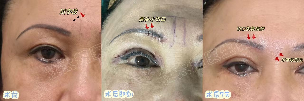 川字纹去除多少钱？不同案例分享效果