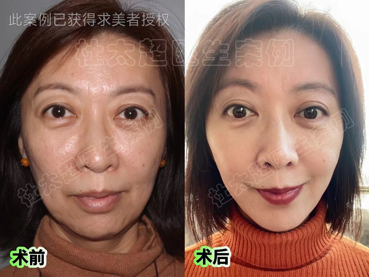 杜太超教授：我做拉皮必须要实现的3个目标！