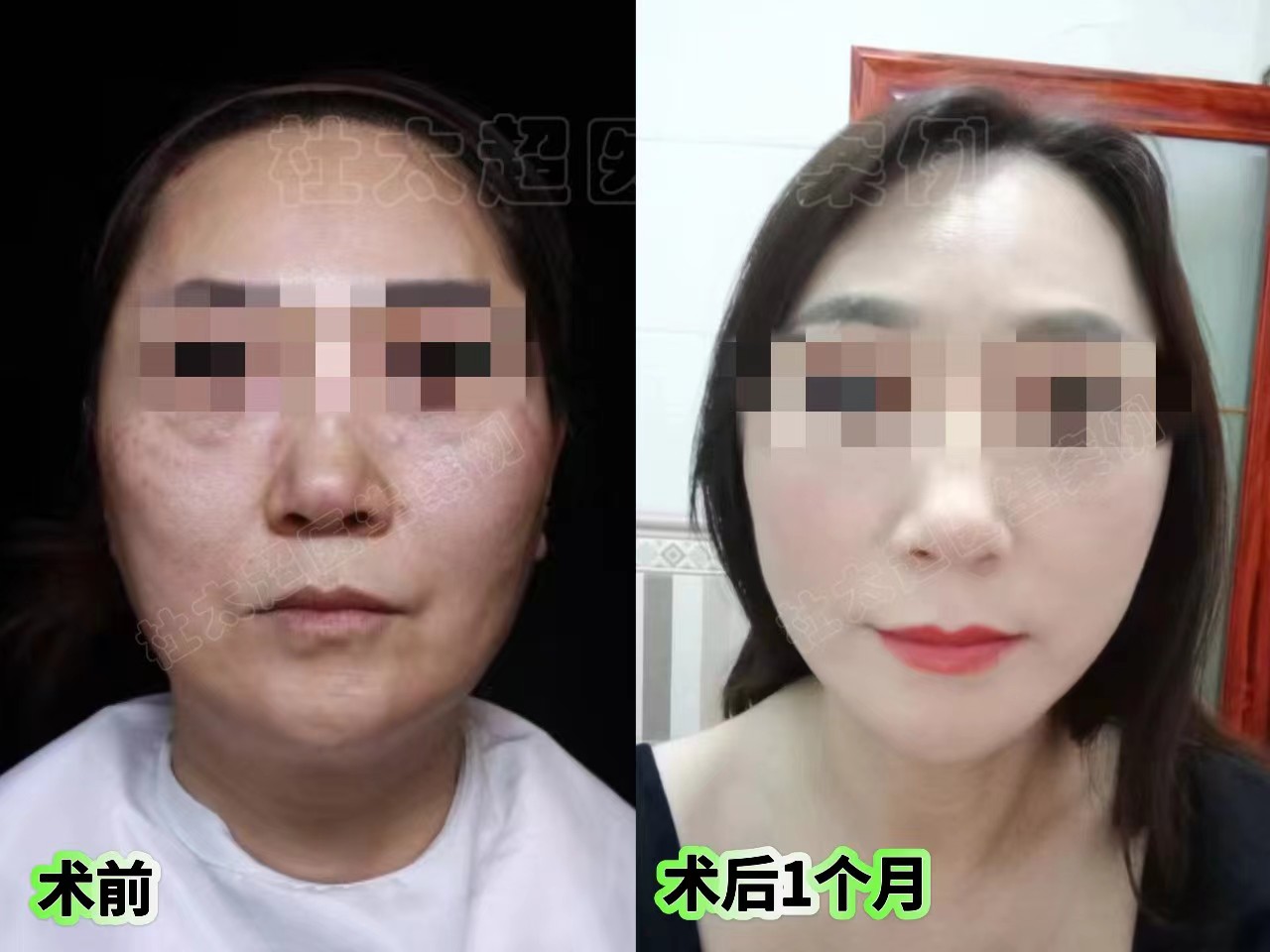 51岁姐姐不服老，挑战拉皮手术，术后恢复惊为天人！