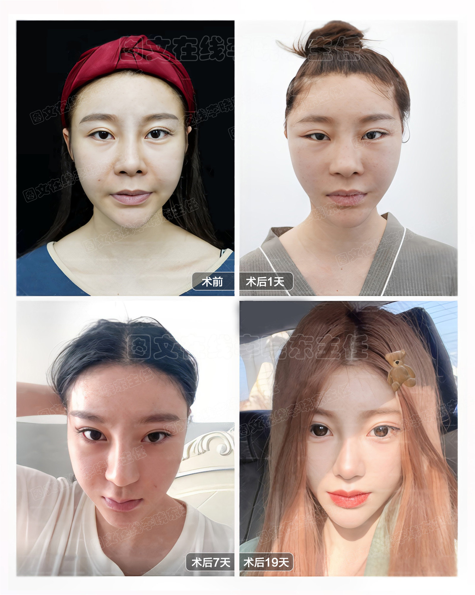 求美者psv面部年轻化