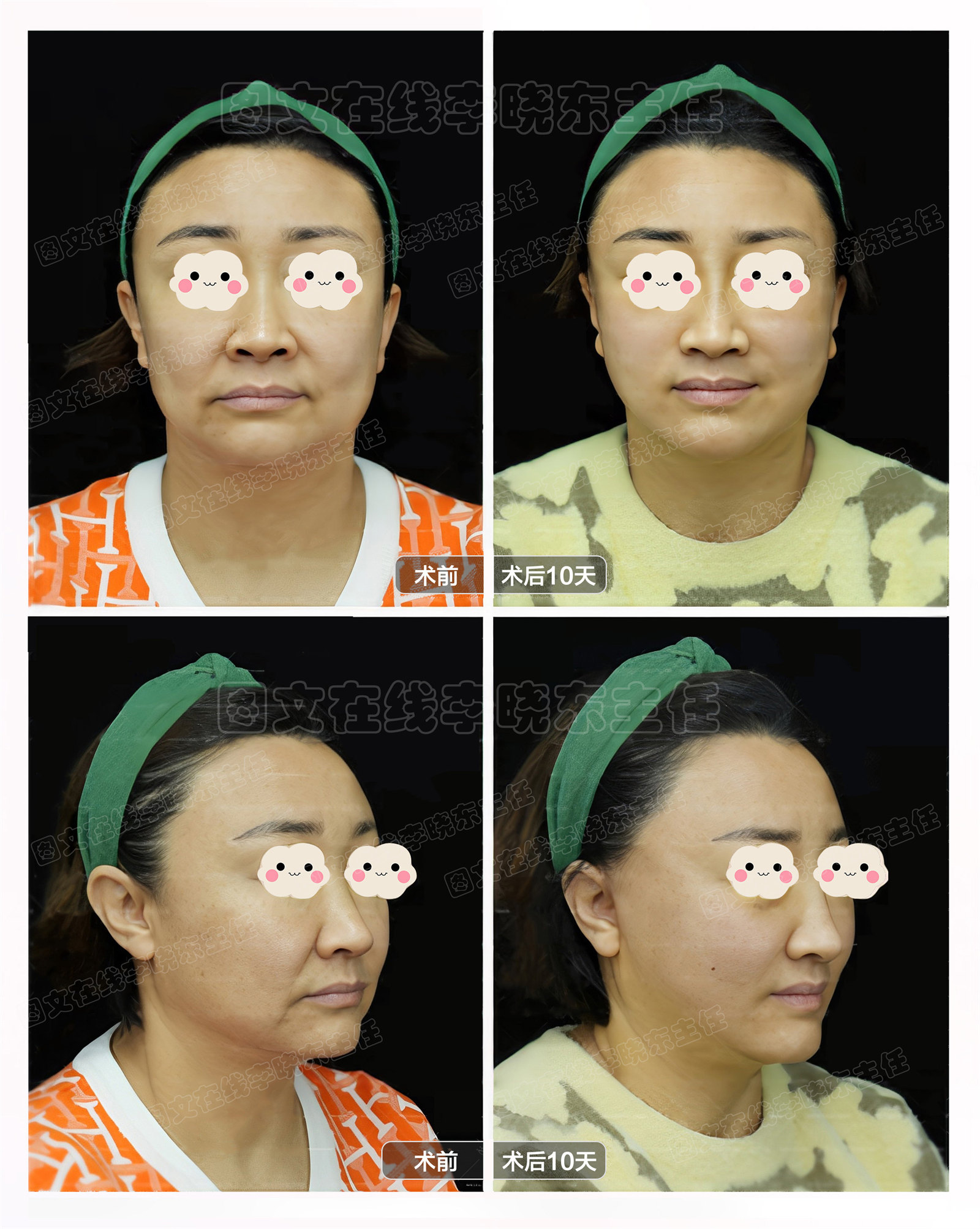 求美者psv面部年轻化