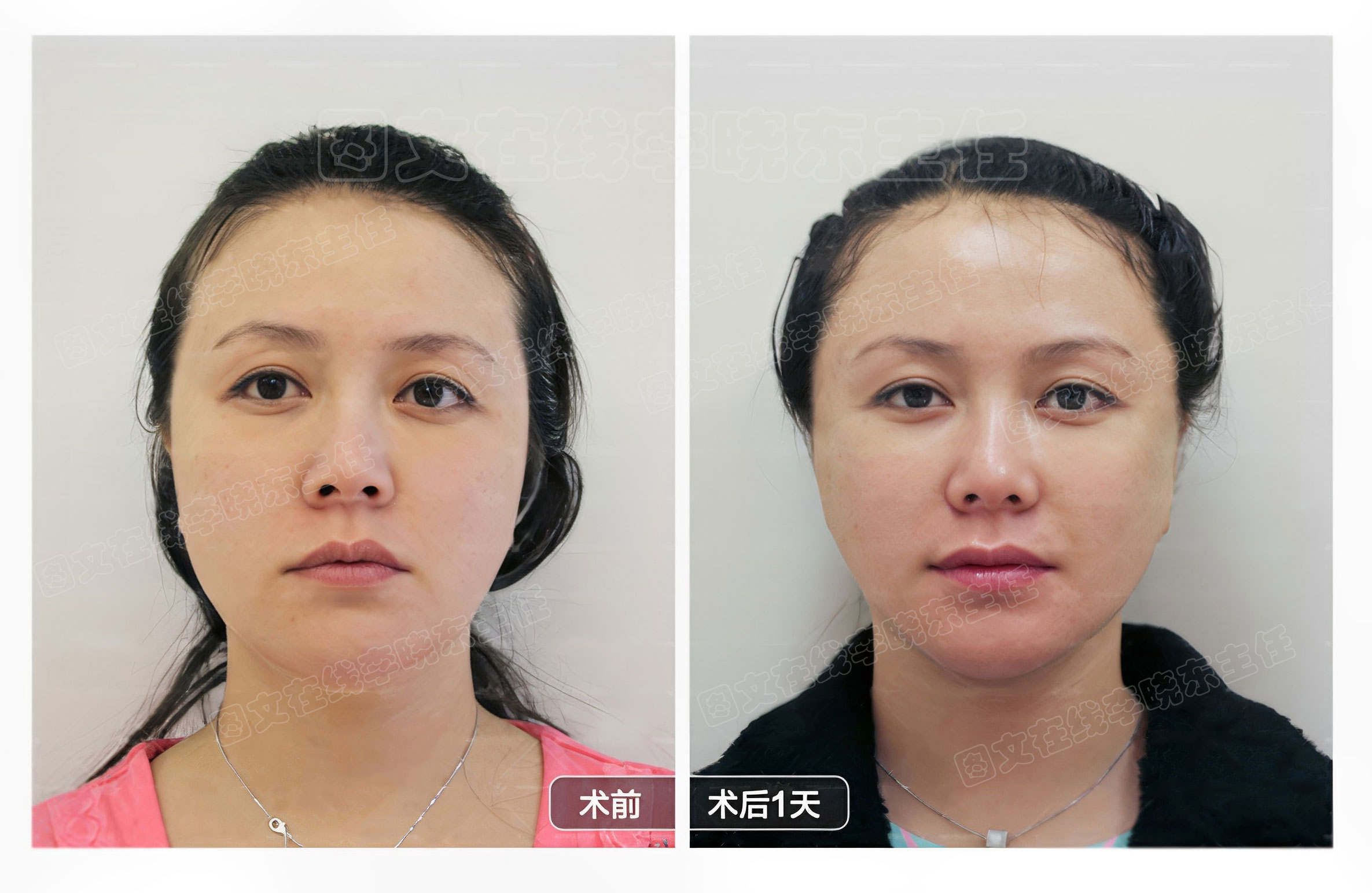 求美者psv面部年轻化