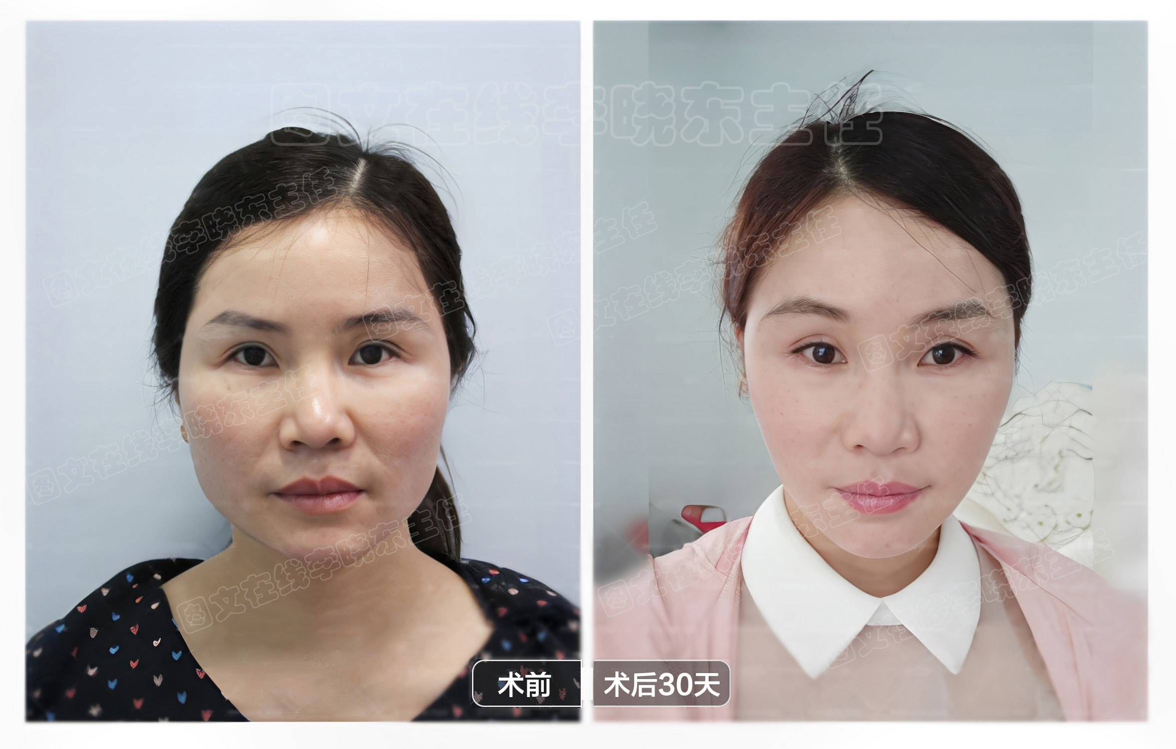 求美者psv面部年轻化