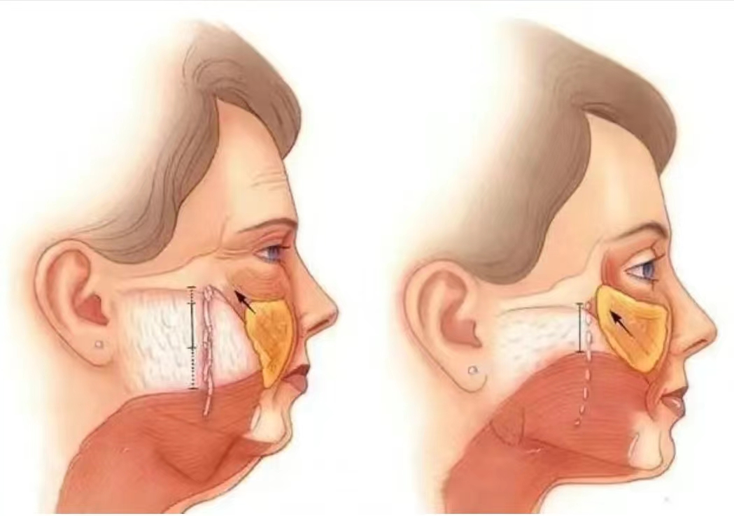 为什么线雕臭名远扬，拉皮手术却风生水起？