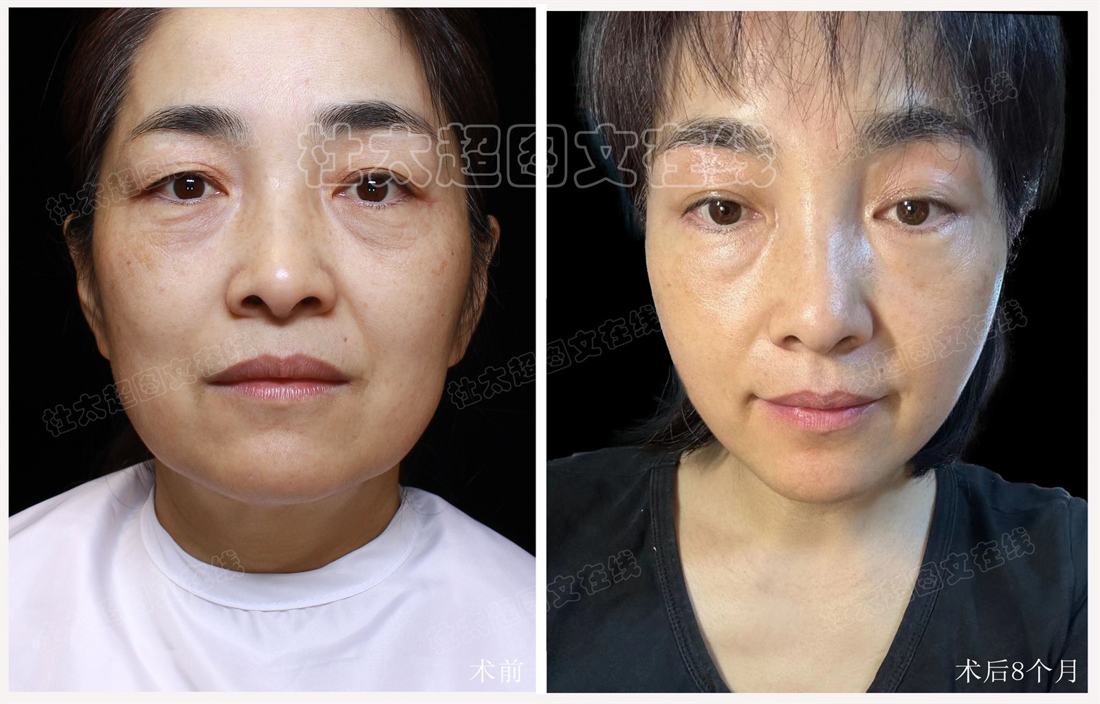 拉皮面部提升术后近期随访45天