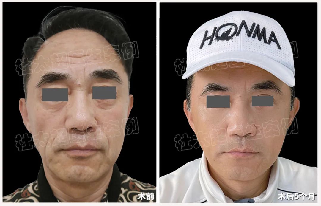 63岁男士“老当益壮”，用拉皮手术开启了他的新式生活！