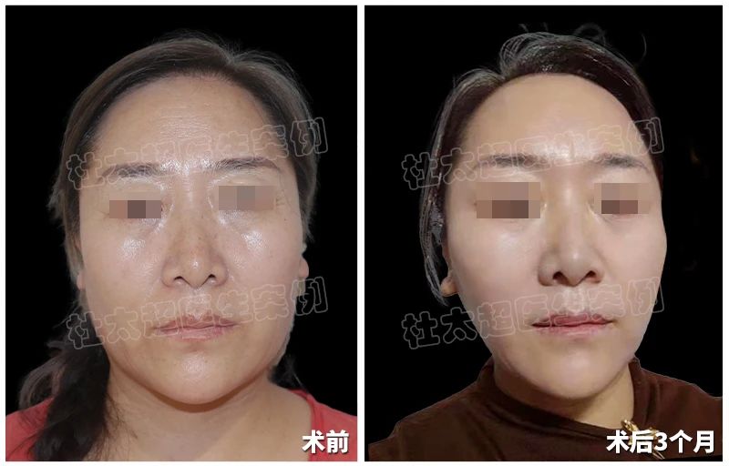 58岁的她如何偷偷回春？拉皮手术3个月后发生翻天覆的变化！