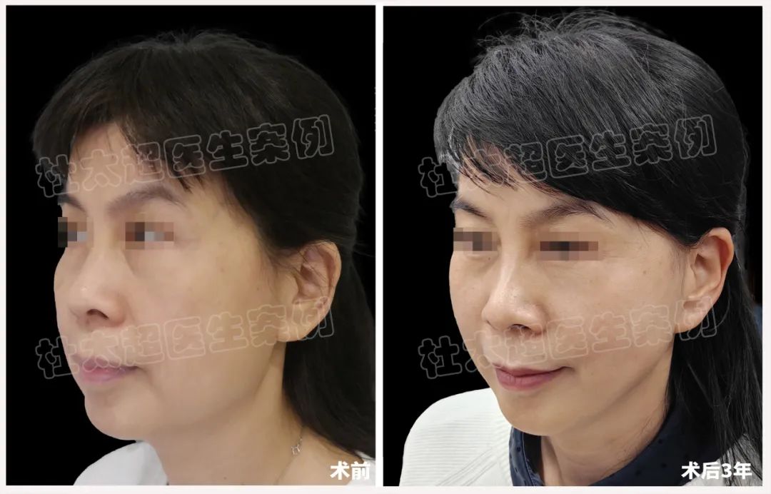 56岁忍受不了他人“恶意”，从惊吓到惊讶的拉皮之旅，真实惊呆了！