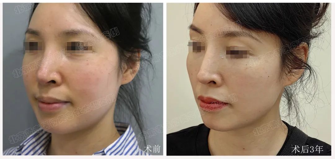 44岁女士做了拉皮手术,术后三年效果让人惊讶不已!他们都不敢相信! 44岁女士做了拉皮手术,术后三年效果让人惊讶不已!他们都不敢相信!