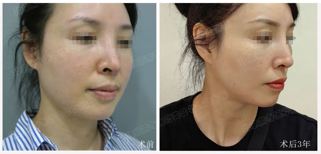 44岁女士做了拉皮手术,术后三年效果让人惊讶不已!他们都不敢相信! 44岁女士做了拉皮手术,术后三年效果让人惊讶不已!他们都不敢相信!