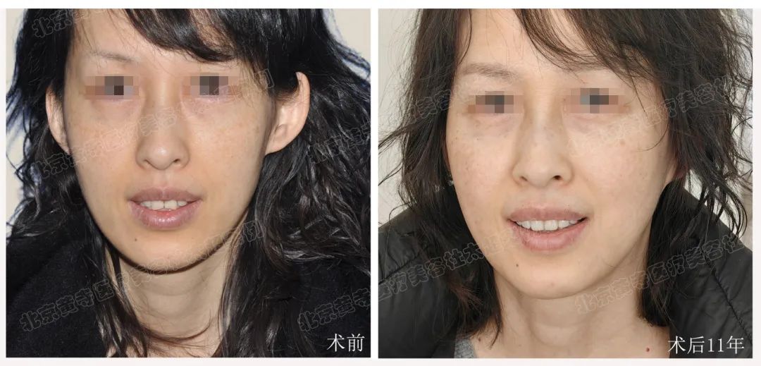 拉皮手术后11年“返场”，她直呼这样的效果是意料之外的！