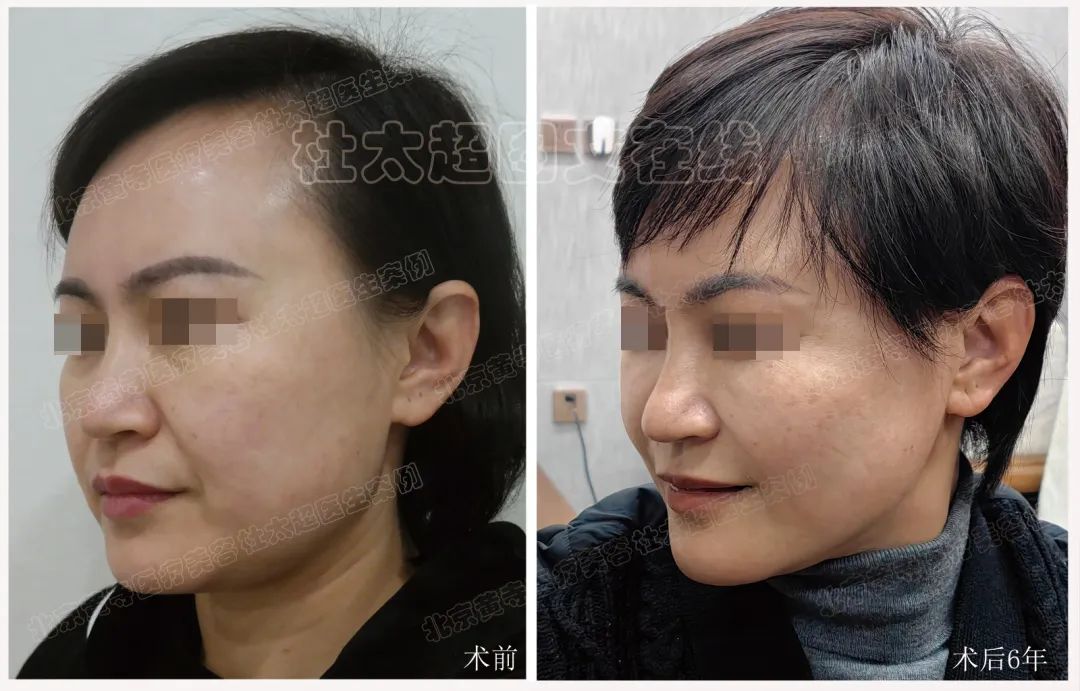 50多岁的我并没有老去!拉皮6年后的真实反馈!拉皮手术真有这么长效吗? 50多岁的我并没有老去!拉皮6年后的真实反馈!拉皮手术真有这么长效吗?