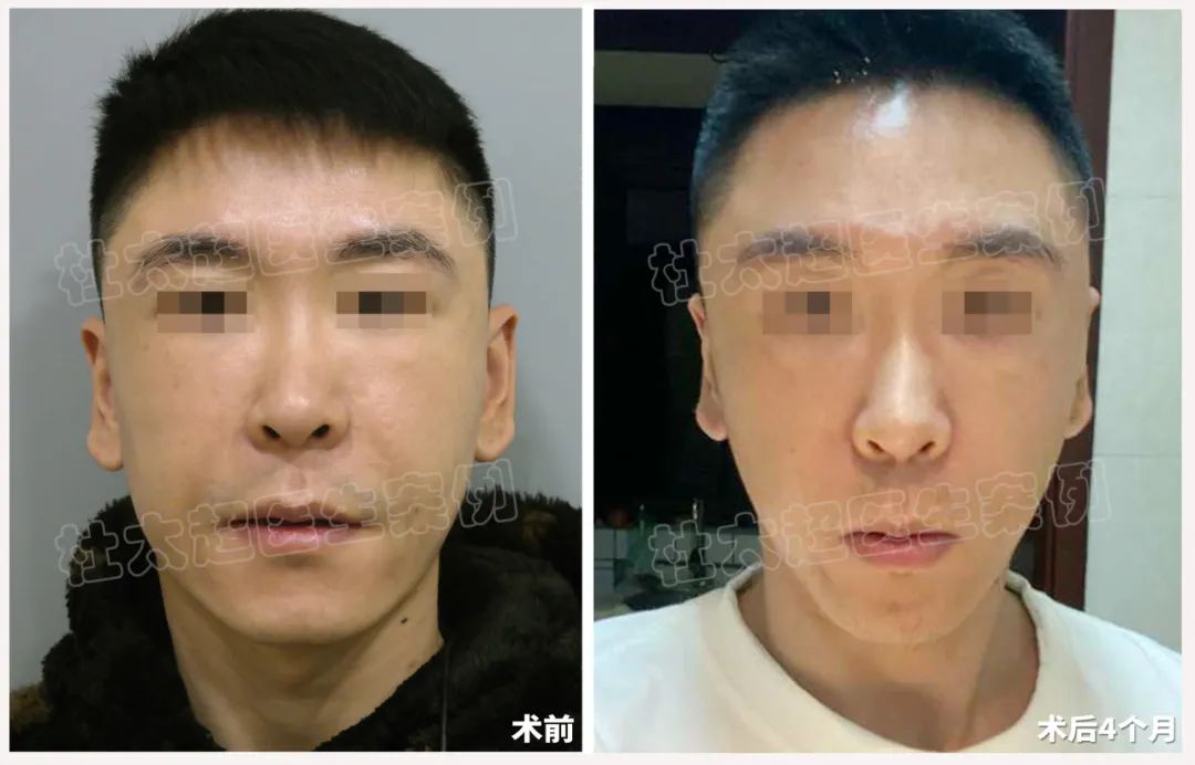 这么年轻就做拉皮?33岁男士拉皮手术术后3年半反馈! 这么年轻就做拉皮?33岁男士拉皮手术术后3年半反馈!