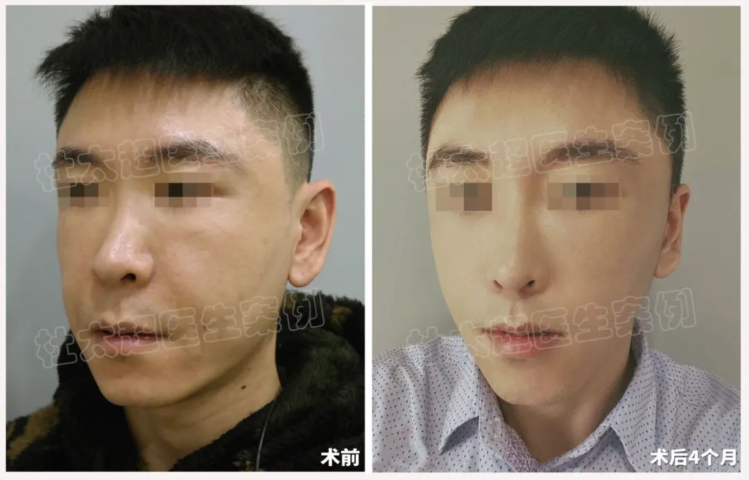 这么年轻就做拉皮?33岁男士拉皮手术术后3年半反馈! 这么年轻就做拉皮?33岁男士拉皮手术术后3年半反馈!
