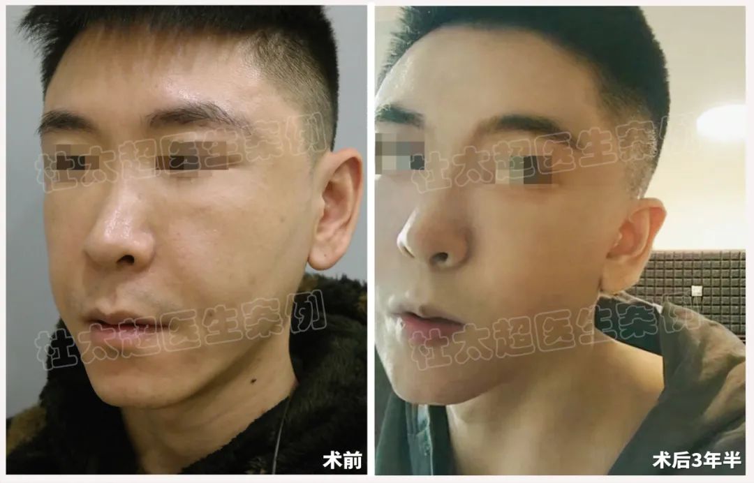 这么年轻就做拉皮?33岁男士拉皮手术术后3年半反馈! 这么年轻就做拉皮?33岁男士拉皮手术术后3年半反馈!