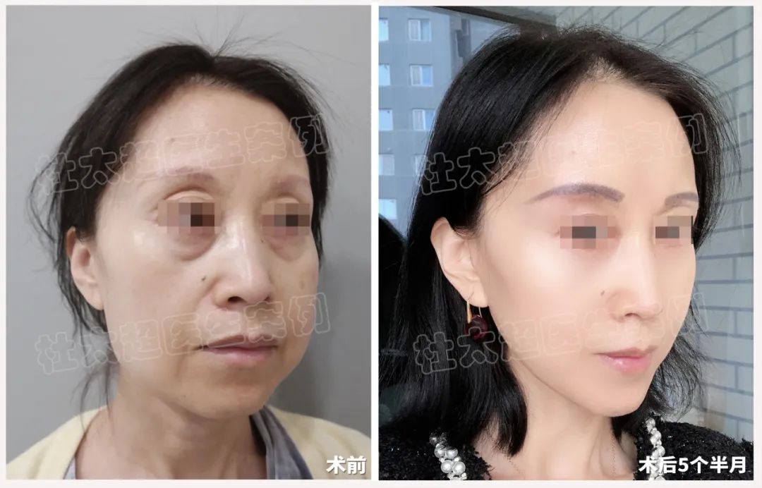 50岁做了拉皮手术，女儿直呼形同姐妹！年轻了至少25岁！