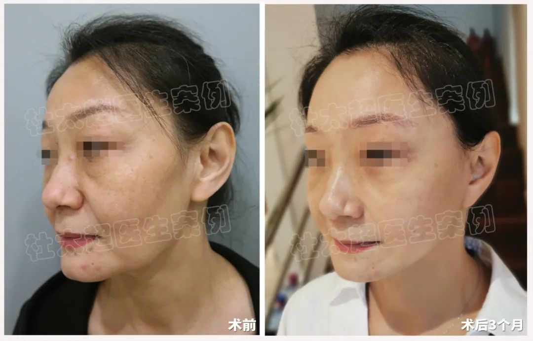 拉皮手术3年从自卑到焦虑,她到底经历了什么!翻天覆地变化让人太惊讶了! 拉皮手术3年从自卑到焦虑,她到底经历了什么!翻天覆地变化让人太惊讶了!