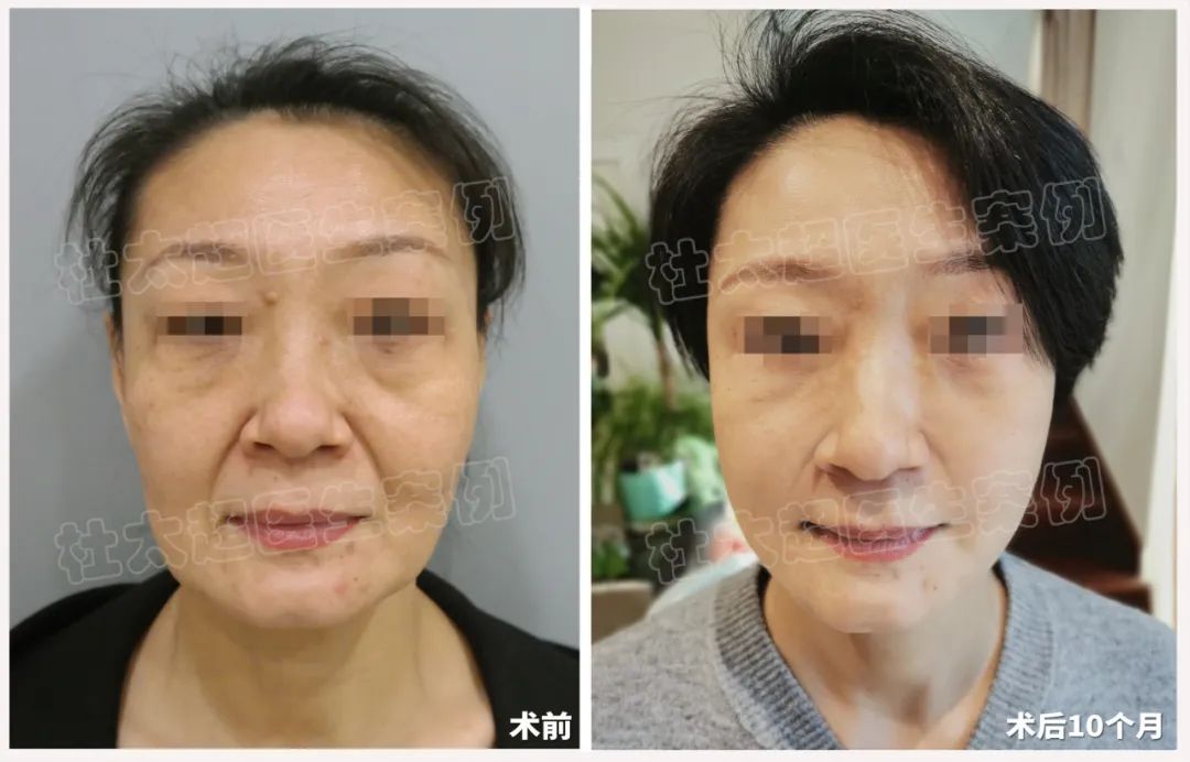 拉皮手术3年从自卑到焦虑,她到底经历了什么!翻天覆地变化让人太惊讶了! 拉皮手术3年从自卑到焦虑,她到底经历了什么!翻天覆地变化让人太惊讶了!