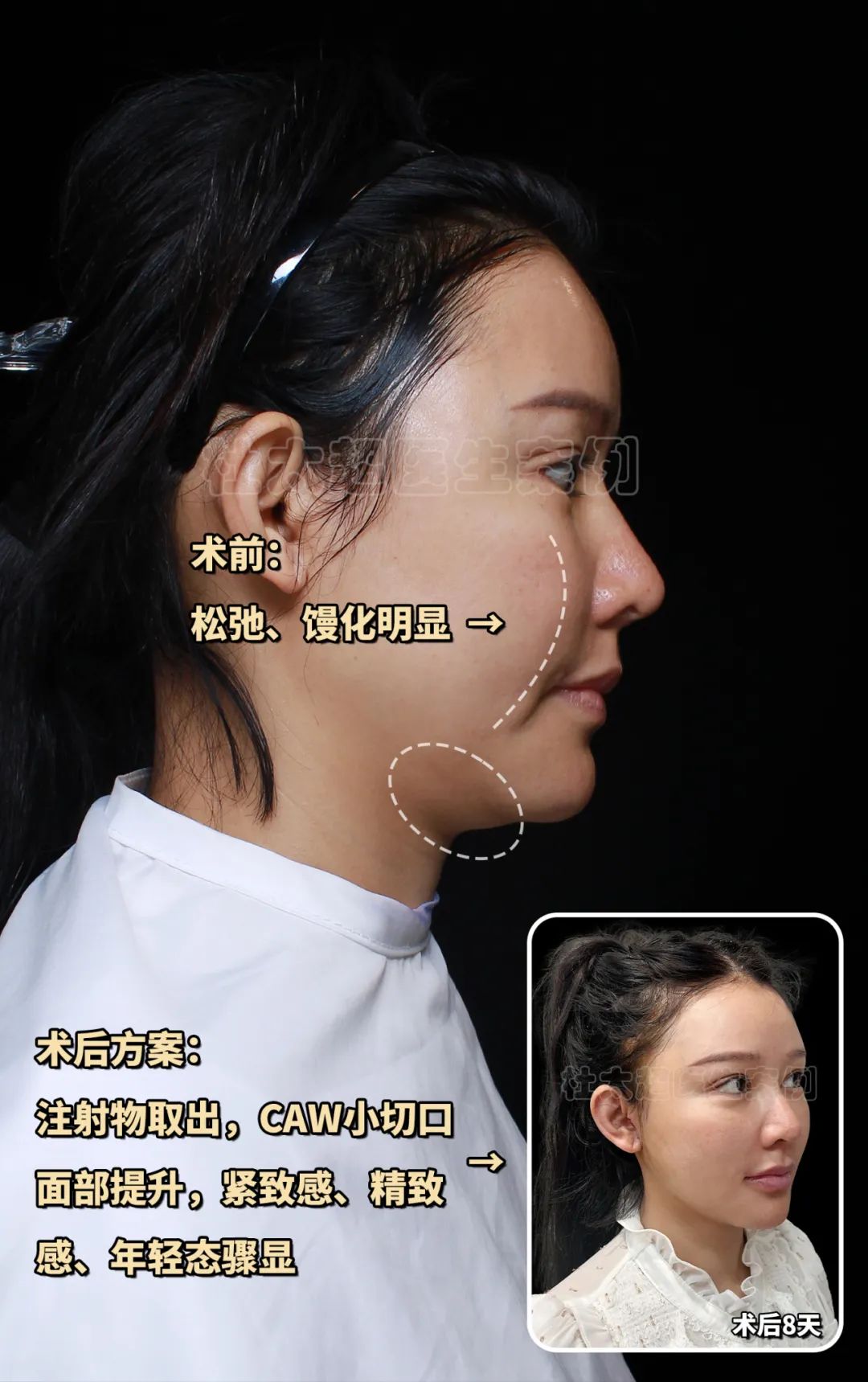 太莽撞了！全脸爆打30多支玻尿酸，面部馒化发泡怎么办？