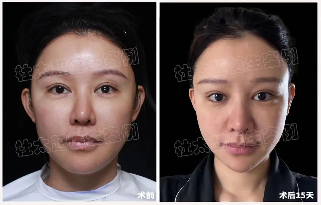 太莽撞了！全脸爆打30多支玻尿酸，面部馒化发泡怎么办？