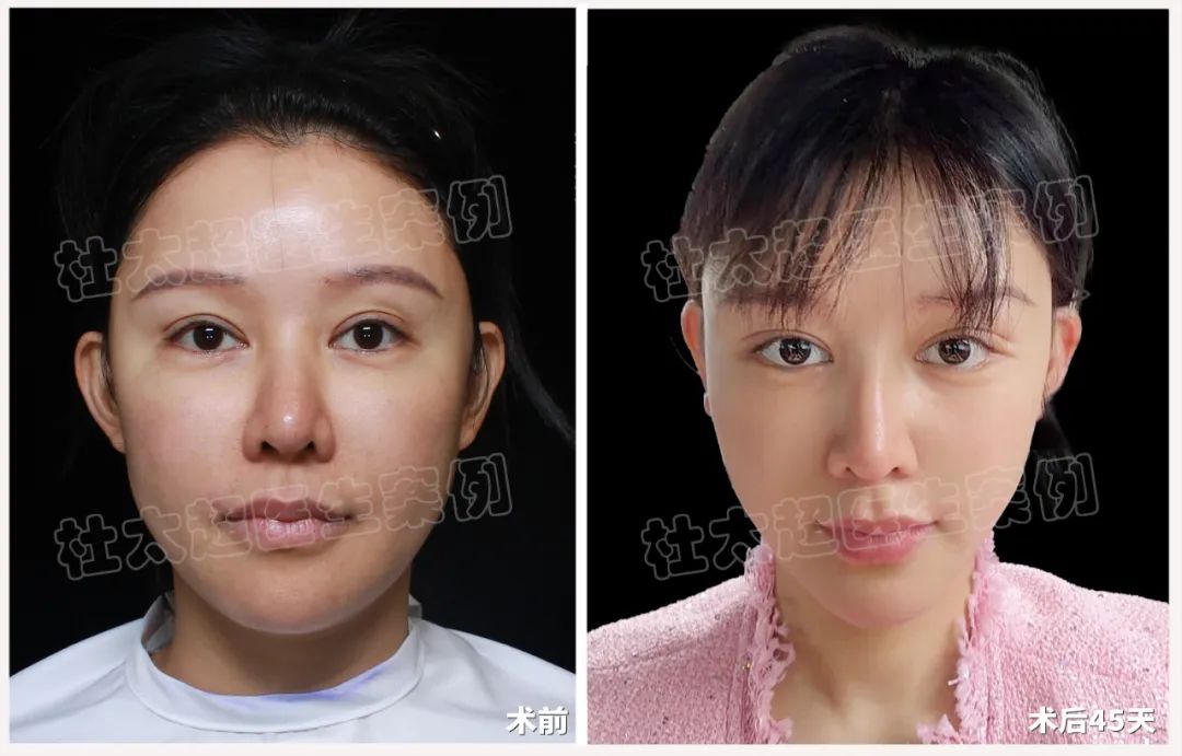 太莽撞了！全脸爆打30多支玻尿酸，面部馒化发泡怎么办？