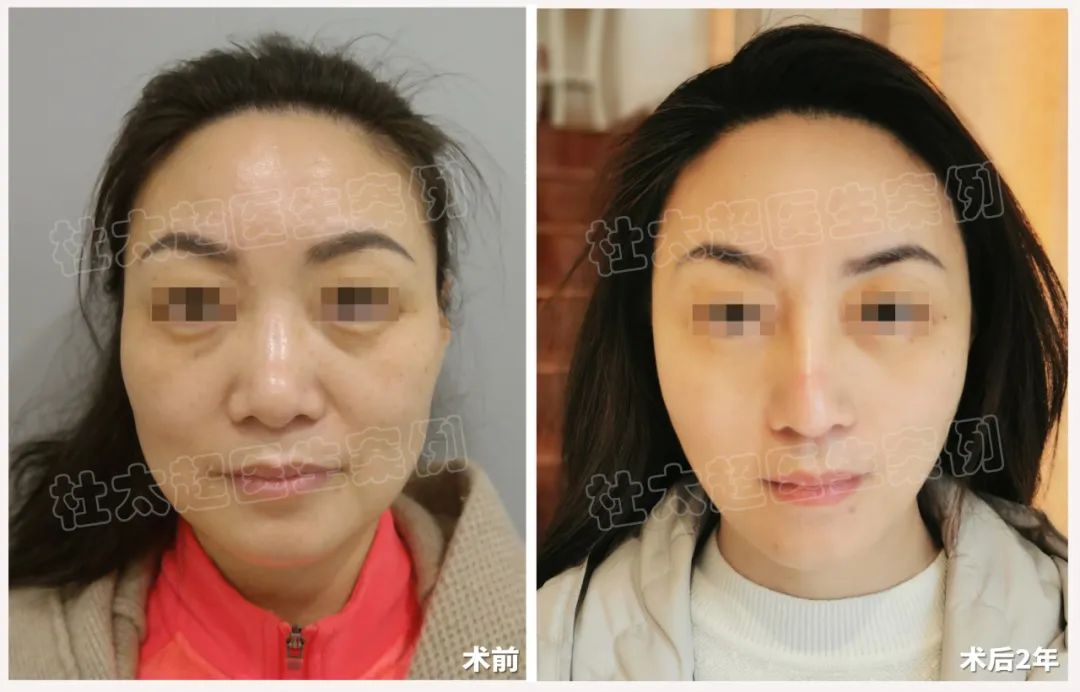 拉皮手术太不可思议了！49岁女性逆生长神话，50还能如40般盛放青春！