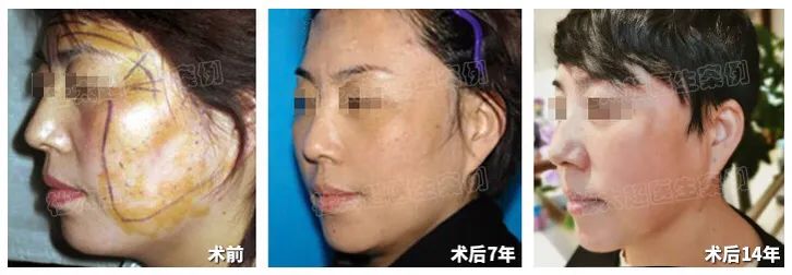 拉皮手术14年不老反而年轻，谁来揭示这个让灵魂都能年轻的秘密？