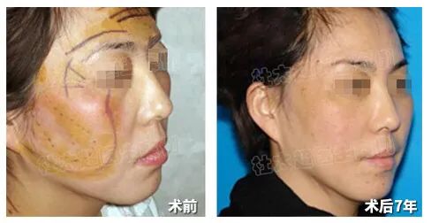 拉皮手术14年不老反而年轻，谁来揭示这个让灵魂都能年轻的秘密？