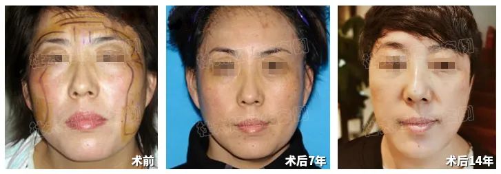 拉皮手术14年不老反而年轻，谁来揭示这个让灵魂都能年轻的秘密？