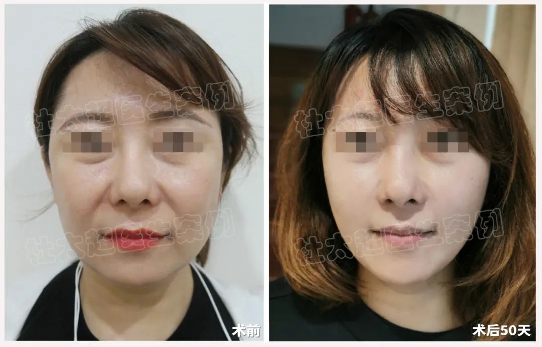 48岁化妆师接受拉皮手术！破茧成蝶，为了更好服务客人，首先要颜值爆表！