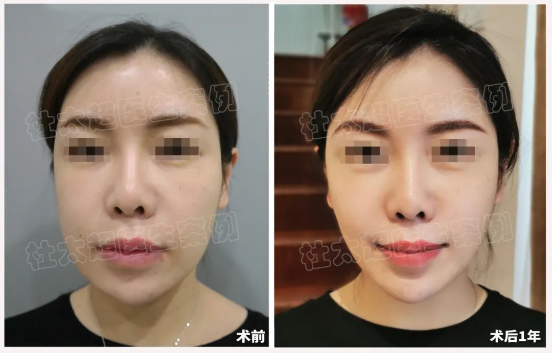 36岁就开始拉皮手术,是否太早啦? 36岁就开始拉皮手术,是否太早啦?