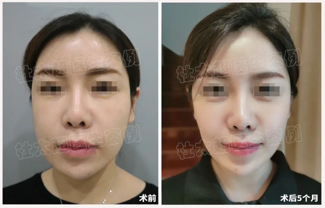 36岁就开始拉皮手术,是否太早啦? 36岁就开始拉皮手术,是否太早啦?