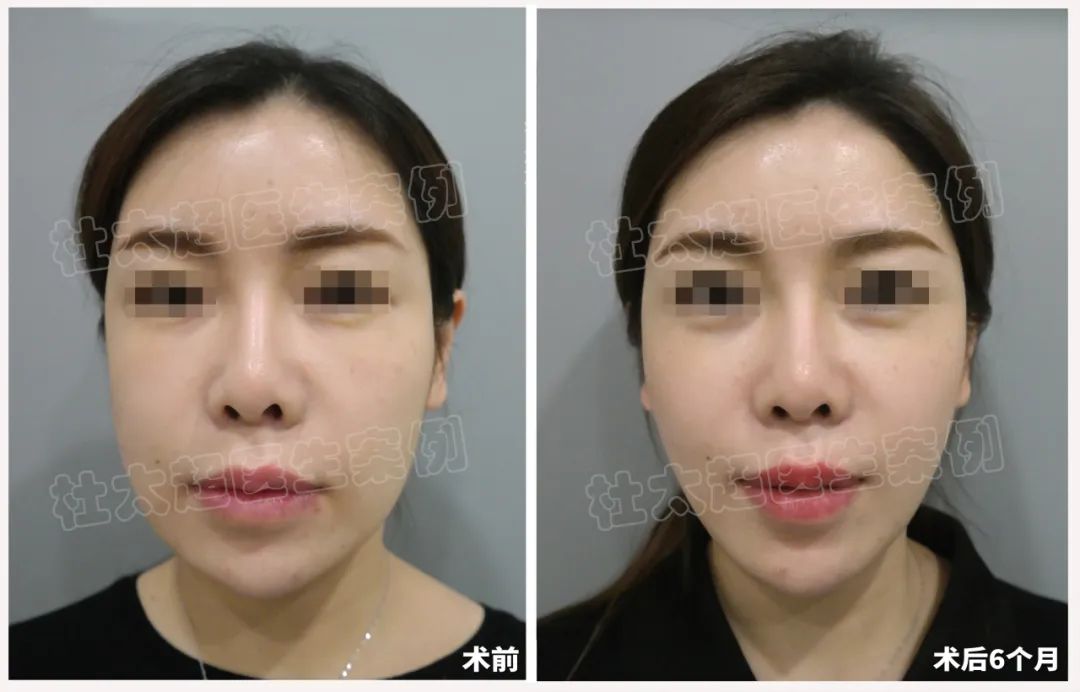 36岁就开始拉皮手术,是否太早啦? 36岁就开始拉皮手术,是否太早啦?