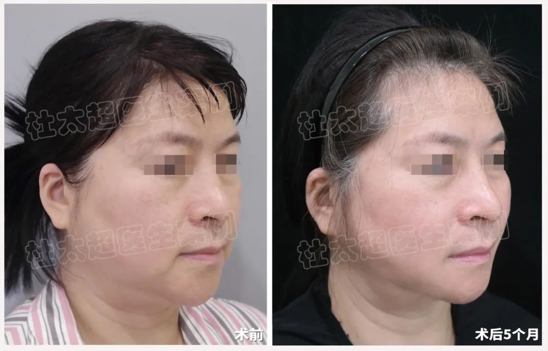 做完眼部手术后不满足！又来做拉皮手术了！这样的效果惊艳到我们了！