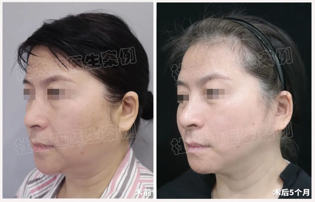 做完眼部手术后不满足！又来做拉皮手术了！这样的效果惊艳到我们了！