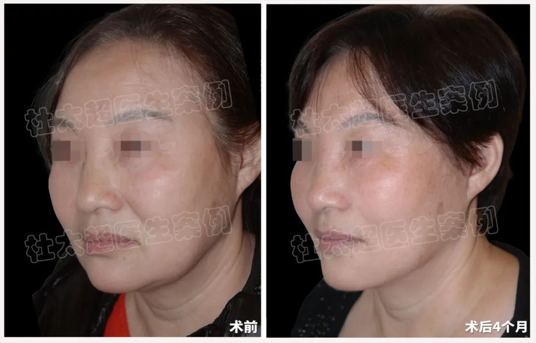 58岁拉皮术后7个月对比，太惊艳了！caw小切口面部提升，让美丽与隐蔽并存。