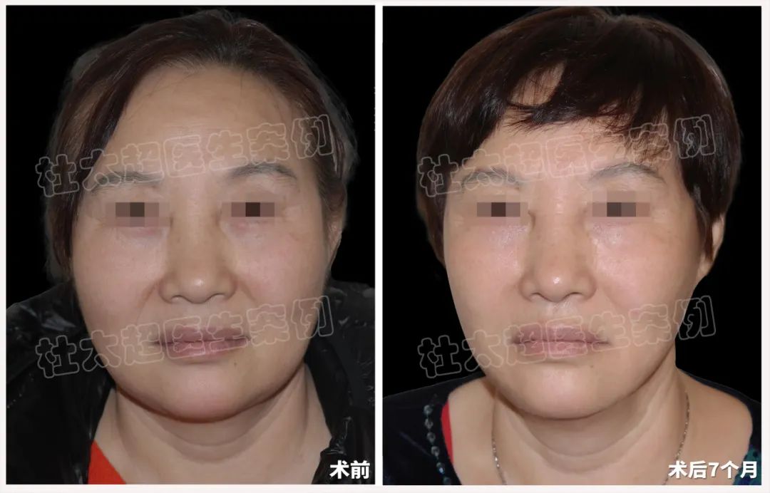 58岁拉皮术后7个月对比，太惊艳了！caw小切口面部提升，让美丽与隐蔽并存。