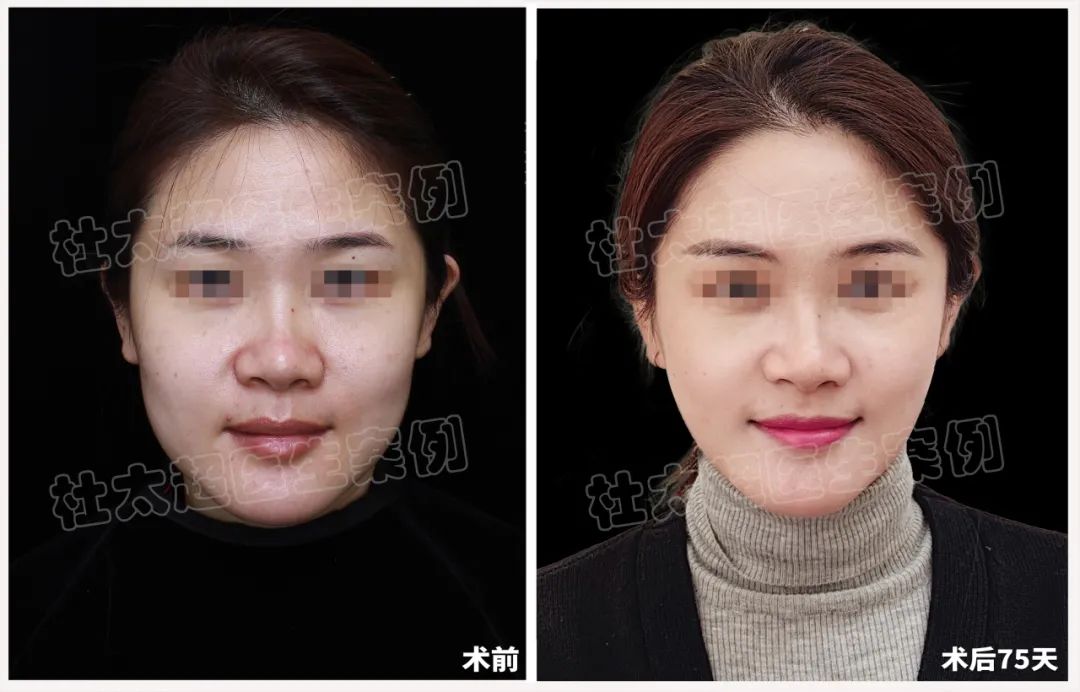 33岁美女律师的模样大改造：拉皮手术塑造精致美丽，专业精神铸就内在力量！