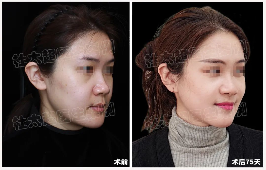 33岁美女律师的模样大改造：拉皮手术塑造精致美丽，专业精神铸就内在力量！