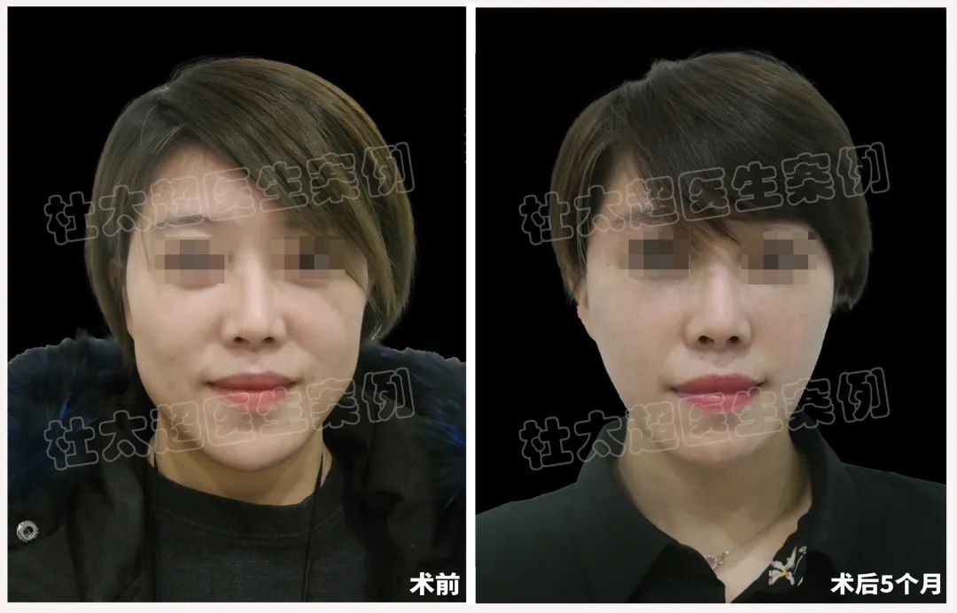 39岁女士挑战现实，拉皮手术重塑自我，重现“永不老去”的女人！