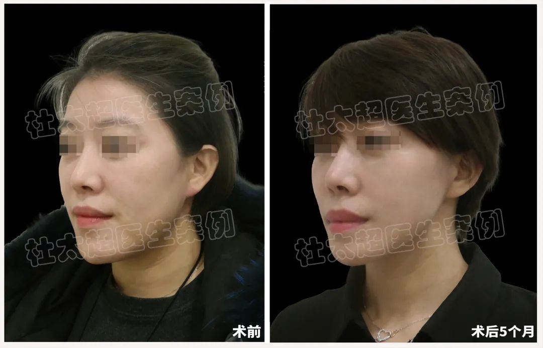 39岁女士挑战现实，拉皮手术重塑自我，重现“永不老去”的女人！