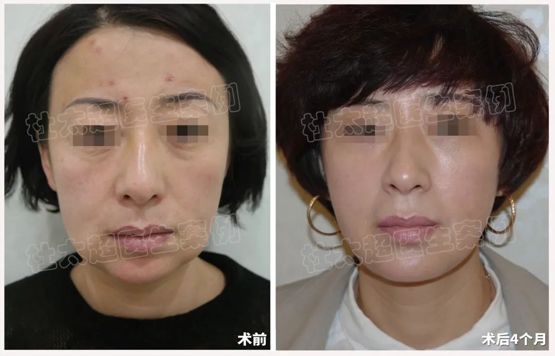 45岁挑战岁月牢笼，caw小切口面部提升术，才是我青春的答案！