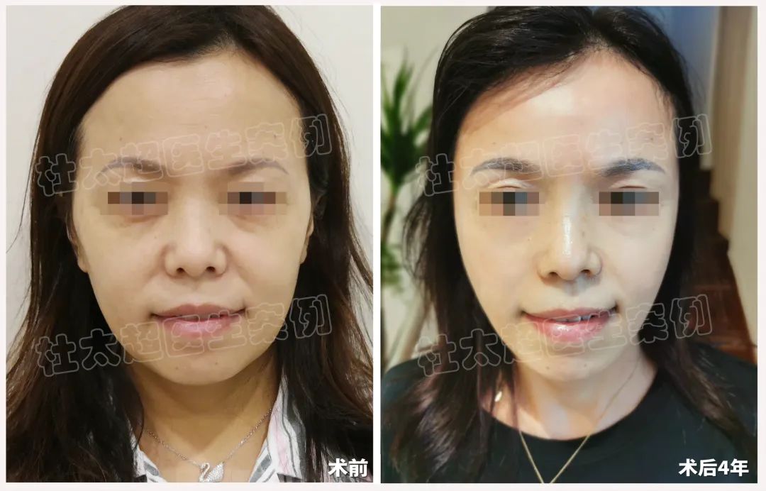 四年时光见证：45岁女性借助拉皮手术成功逆袭青春！