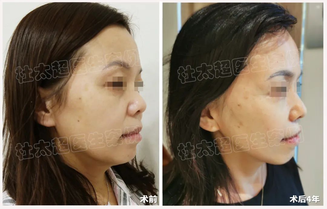 四年时光见证：45岁女性借助拉皮手术成功逆袭青春！