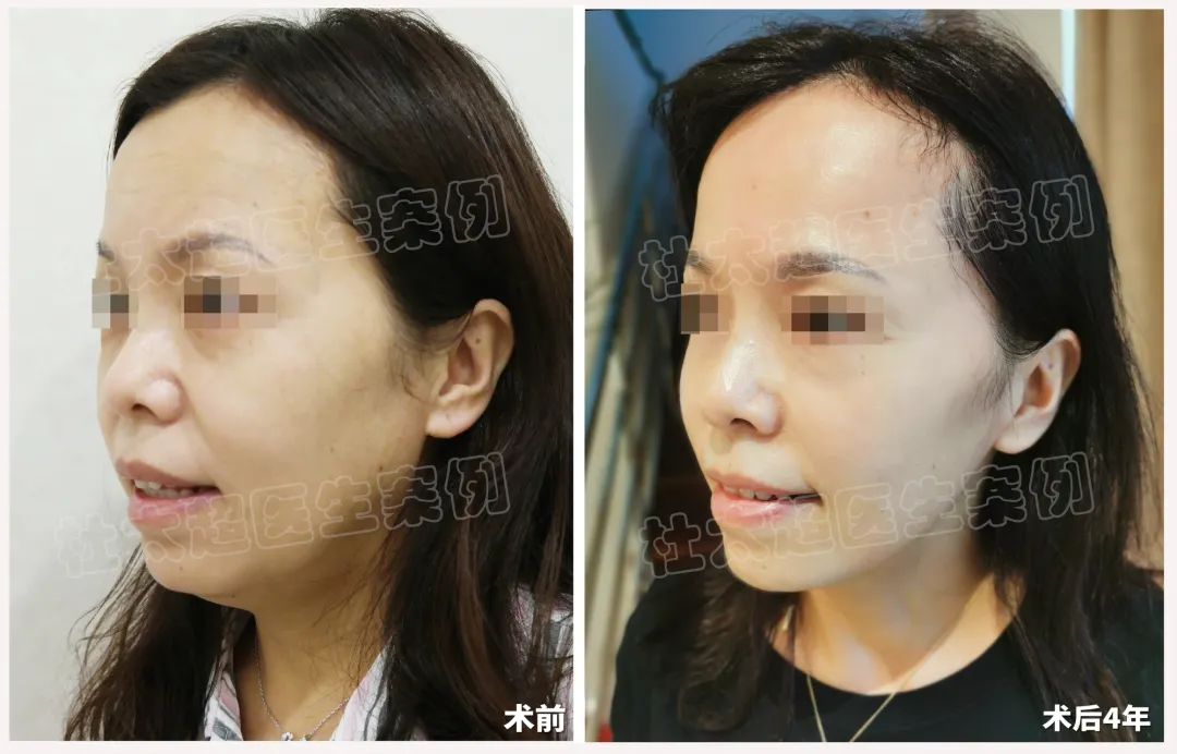 四年时光见证：45岁女性借助拉皮手术成功逆袭青春！