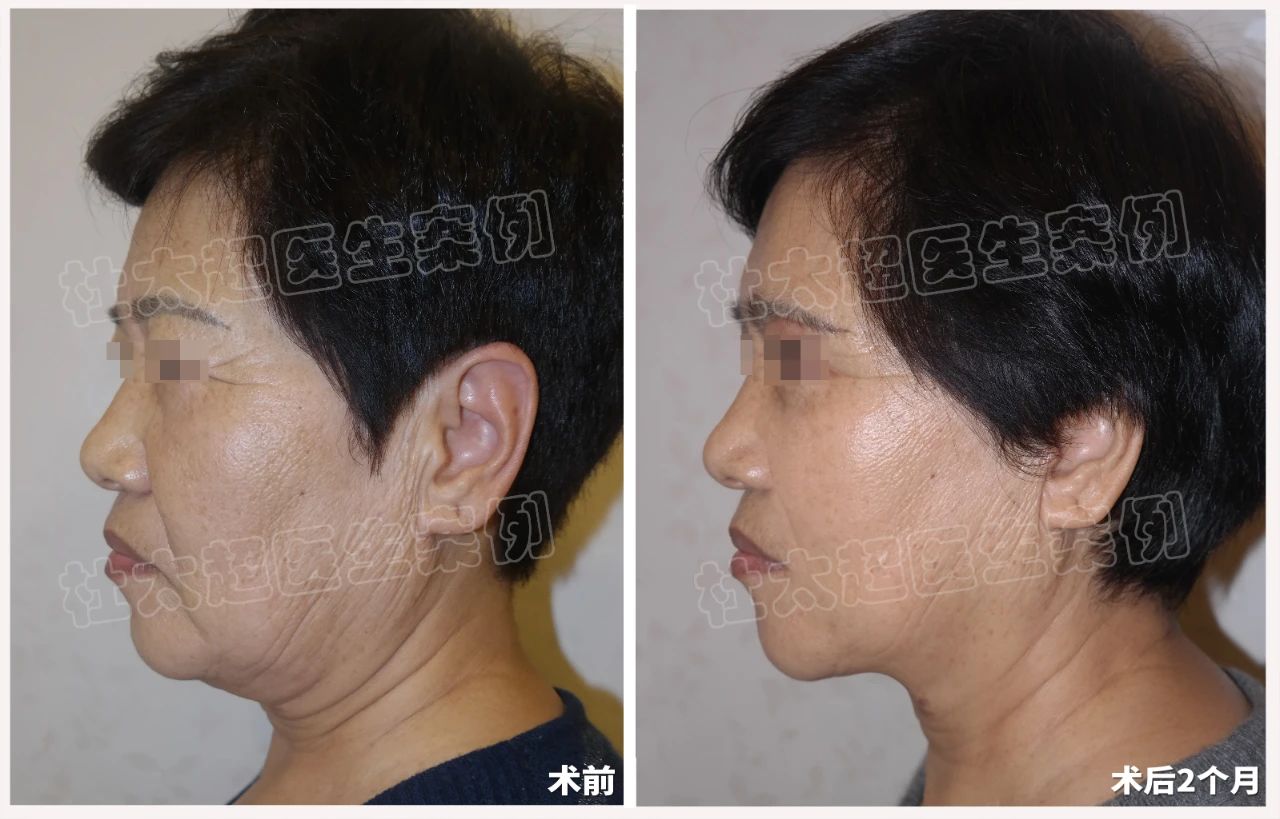 64岁通过拉皮手术逆龄回春，术后2个月向美丽出发！