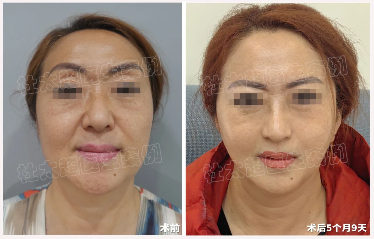 五个月蜕变：56岁求美者通过拉皮手术打造紧致年轻态！