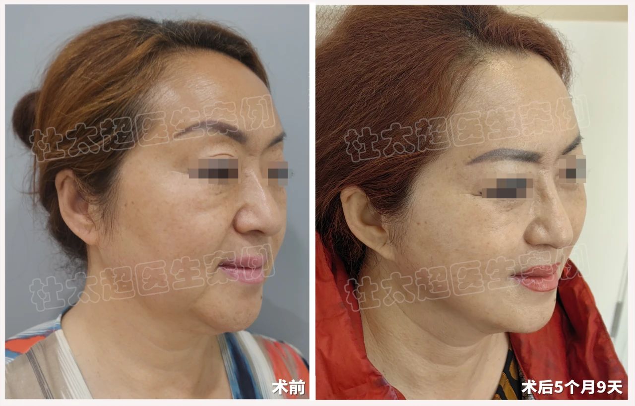 五个月蜕变：56岁求美者通过拉皮手术打造紧致年轻态！