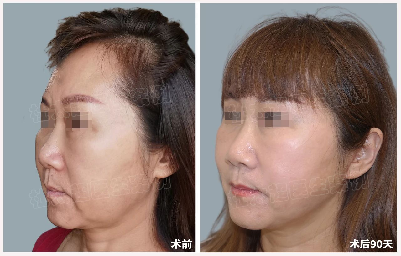 告别"馒化"大妈脸，拥抱紧致青春颜！54岁女士的惊人蜕变，您也能拥有！